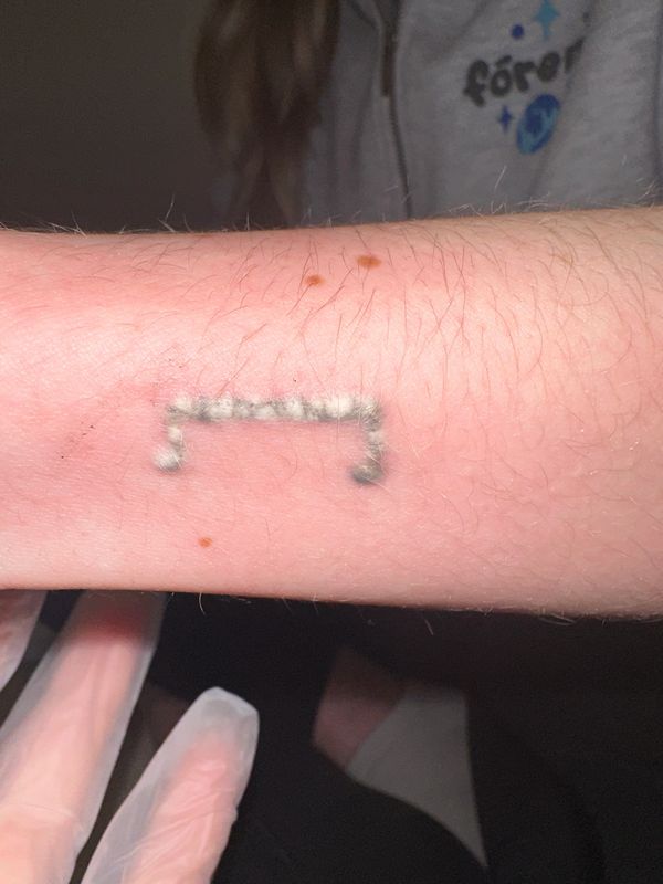 tattoo removal, safe tattoo removal, does tattoo removal scar, laser tattoo removal treatment