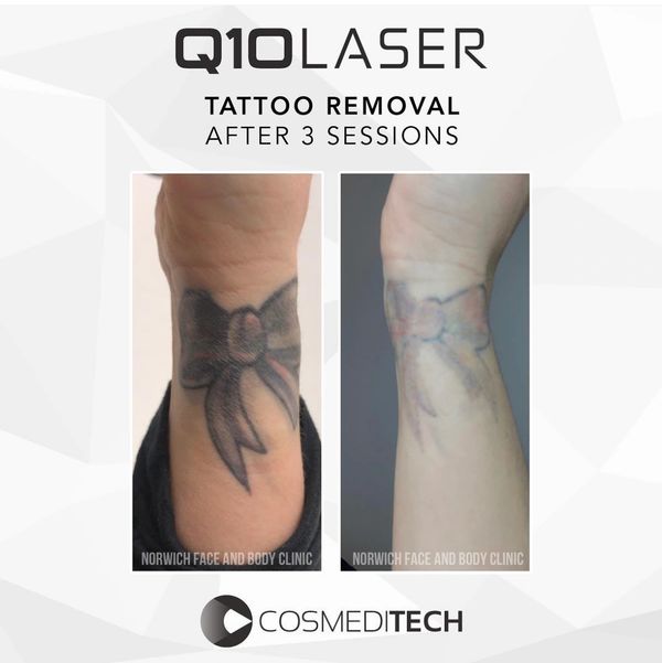 Cosmeditech’s results using the Q10 laser. Tattoo removal that works, laser clinic west yorkshire
