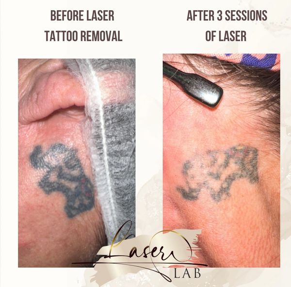 Laser tattoo removal treatment, knottingley tattoo removal, laser tattoo removal, laser, yorkshire
