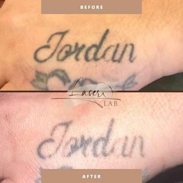 Wakefield laser tattoo removal Local tattoo removal Knottingley safe tattoo removal near me