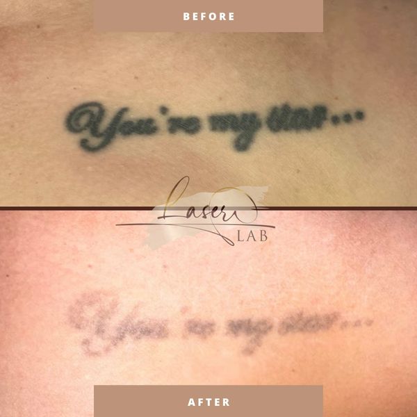 Tattoo removal Knottingley, West Yorkshire laser tattoo removal, ink removal, tattoo removal near me