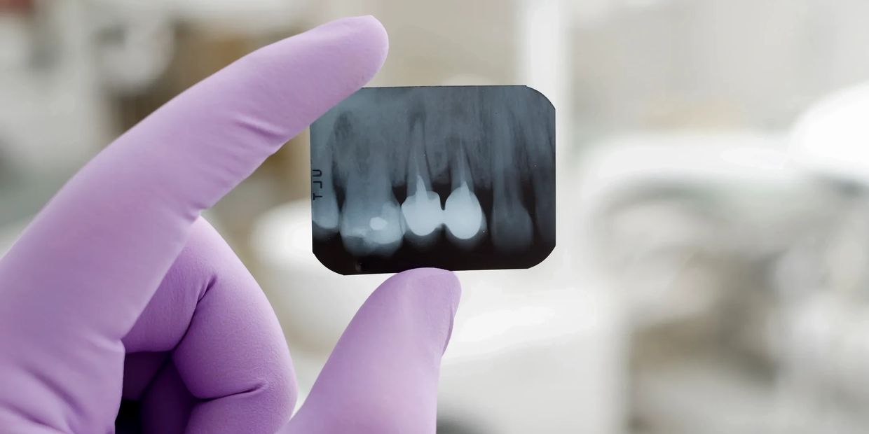 An X-ray used for periodontal procedures in Sherman Oaks, CA
