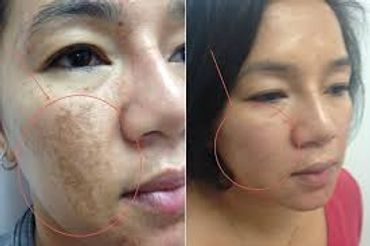 Melasma Removal Clinic