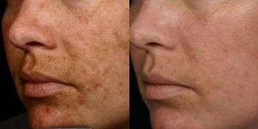 Melasma Removal Clinic