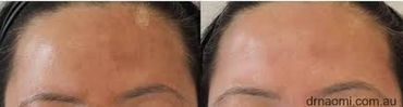 Melasma Removal Clinic