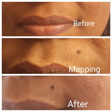 Close-up of skincare treatment showing before, mapping, and after stages.