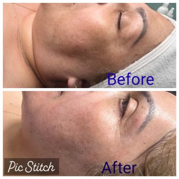 Before and after skin treatment showing reduced pigmentation and smoother skin.