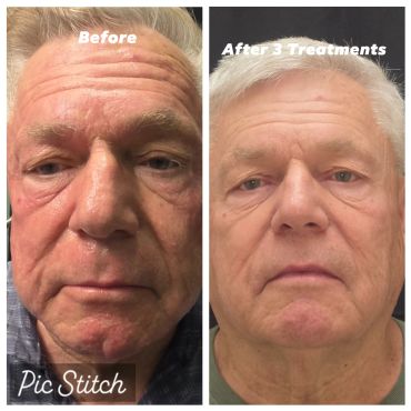 Before and after wrinkle treatment results on an elderly man's face.
