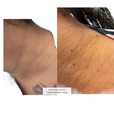 Before and after skin treatment on neck area.
