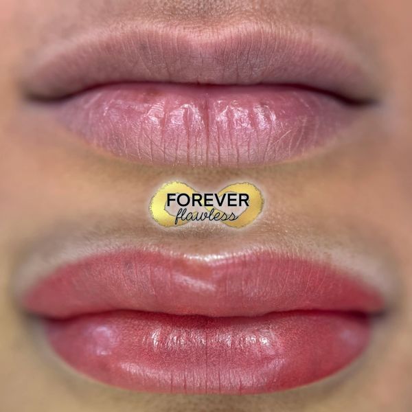 Lip Neutralization in Barrie