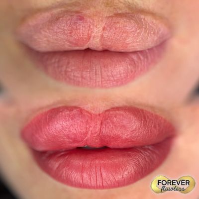 Restorative lip blush cleft palate reconstructive lip surgery