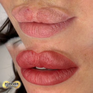 Lip Blush on Cleft Palate Reconstruction
