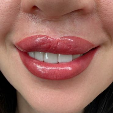 Restorative Lip Blush Barrie Cleft Palate Reconstruction