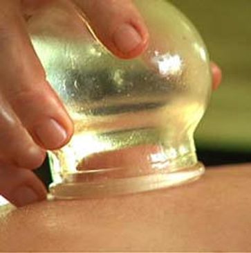 #cupping#therapy