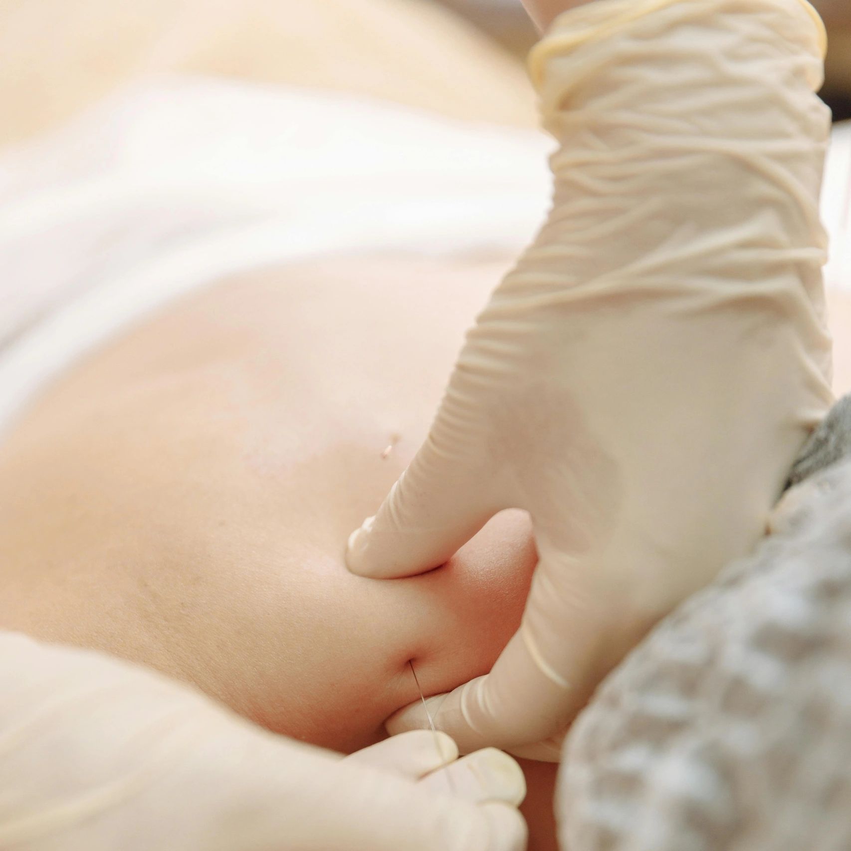Physiotherapist performing dry needling with gloves on a patient's back.