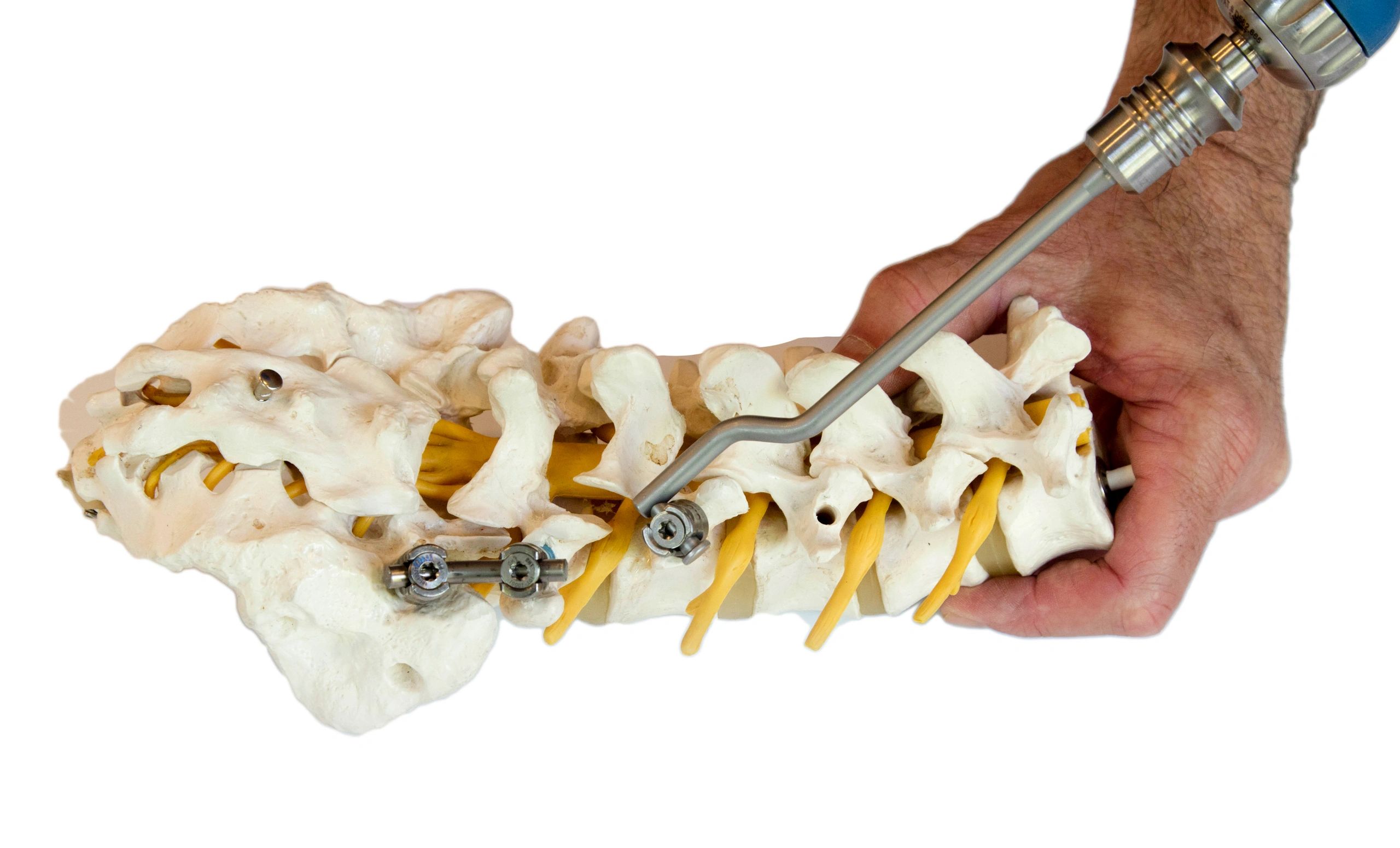 Hardware Removal Spine