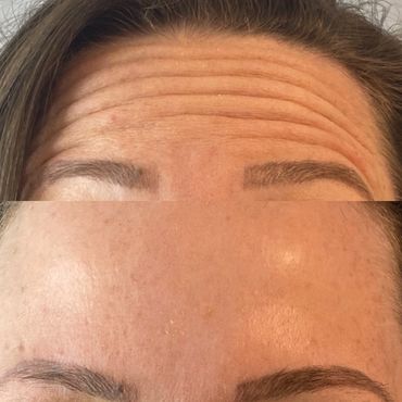 smoothing of skin on forehead using Botox injections