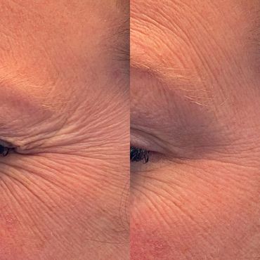 Botox Injection "crows feet"