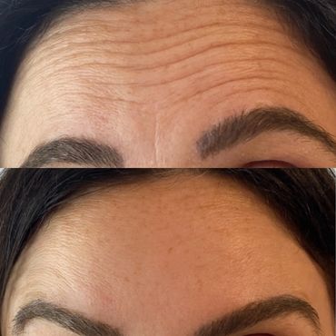 smoothing of forehead and between eyes using xeomin