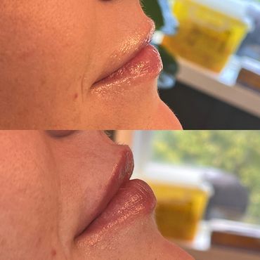 Mini lip plump with dermal filler.
