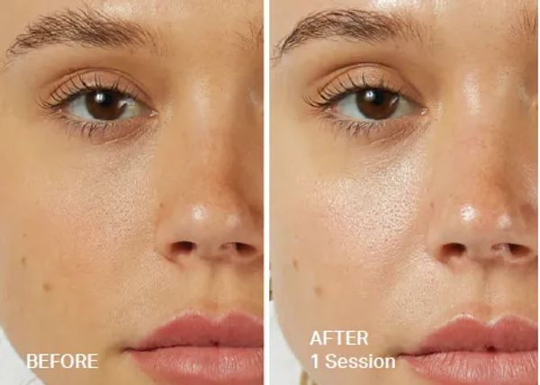 Hydrafacial Treatment