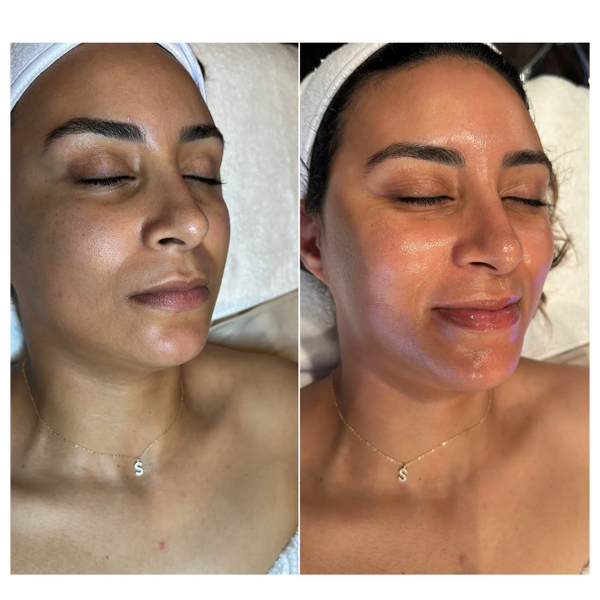 Hydrafacial Treatment Results
