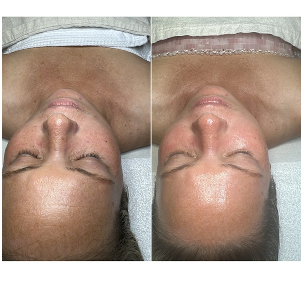 Hydrafacial Treatment Results