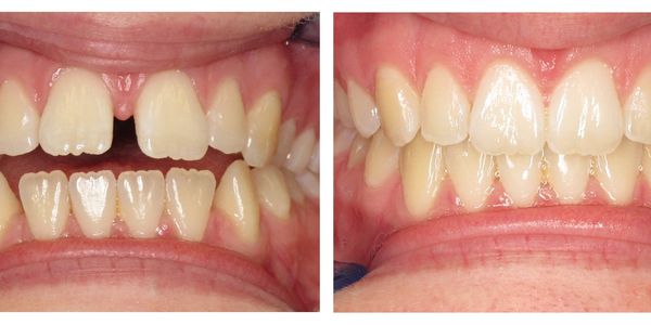 Before and after Invisalign treatment 