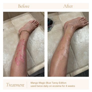 Mango Magic / Psoriasis