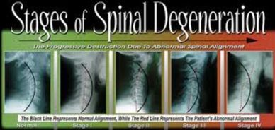 Spinal Decay