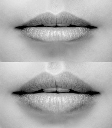 Lips after filler injections