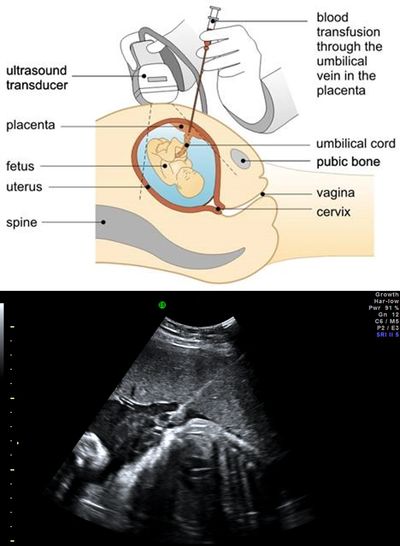 Fetal blood transfusion
