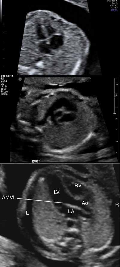 Fetal echocardiography