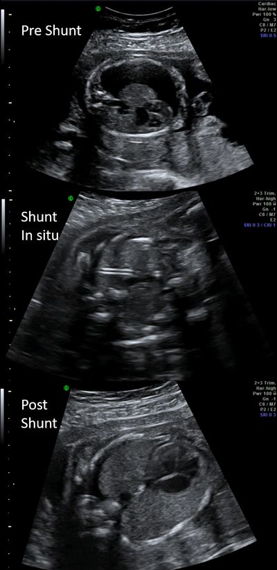 Fetal Thoracic shunt for pleural effusion