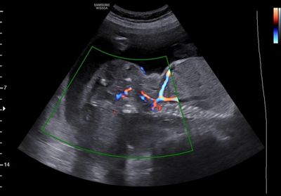 Large Sacrococcygeal teratoma with vascularity