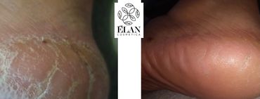 Testimonio de pie reseco. Antes y después de usar el iNourish