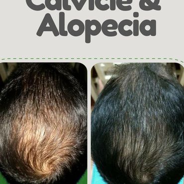 Testimonio por el uso de iHair para calvicie y alopecia