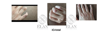 Testimonio de quemadura de 2º grado tratada con iCristal