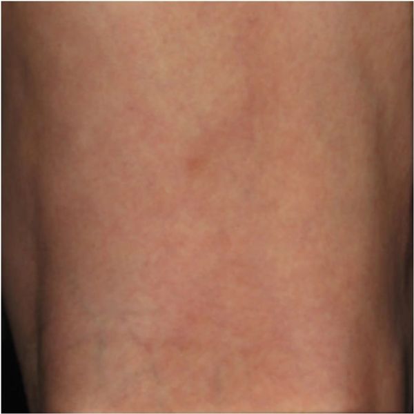 After treatment with 1% Asclera