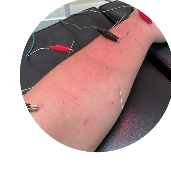 Acupuncture needles with electrical clips on an arm.