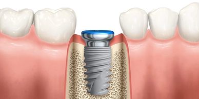 Dental implant and denture to replace missing teeth.