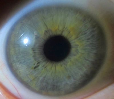 About Iridology