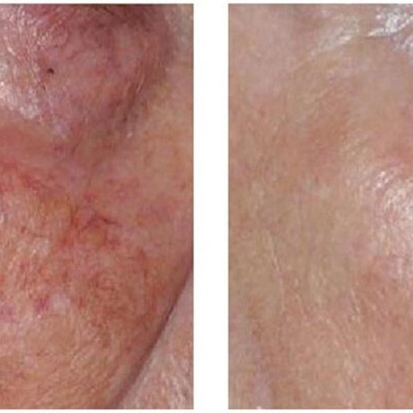 Vascular and Pigmented Lesions