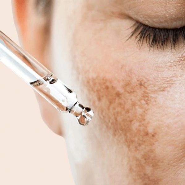 Melasma Treatment