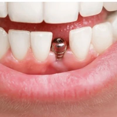 Dental implant screw fixed to the gums to cover the gap for missing tooth.