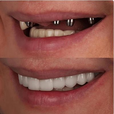 Before and After of Prosthodontic case of dental Implant procedure.