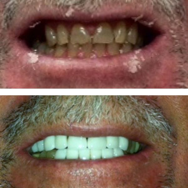 Veneers which are basically false fronts applied to the teeth can be used to make almost instant cos