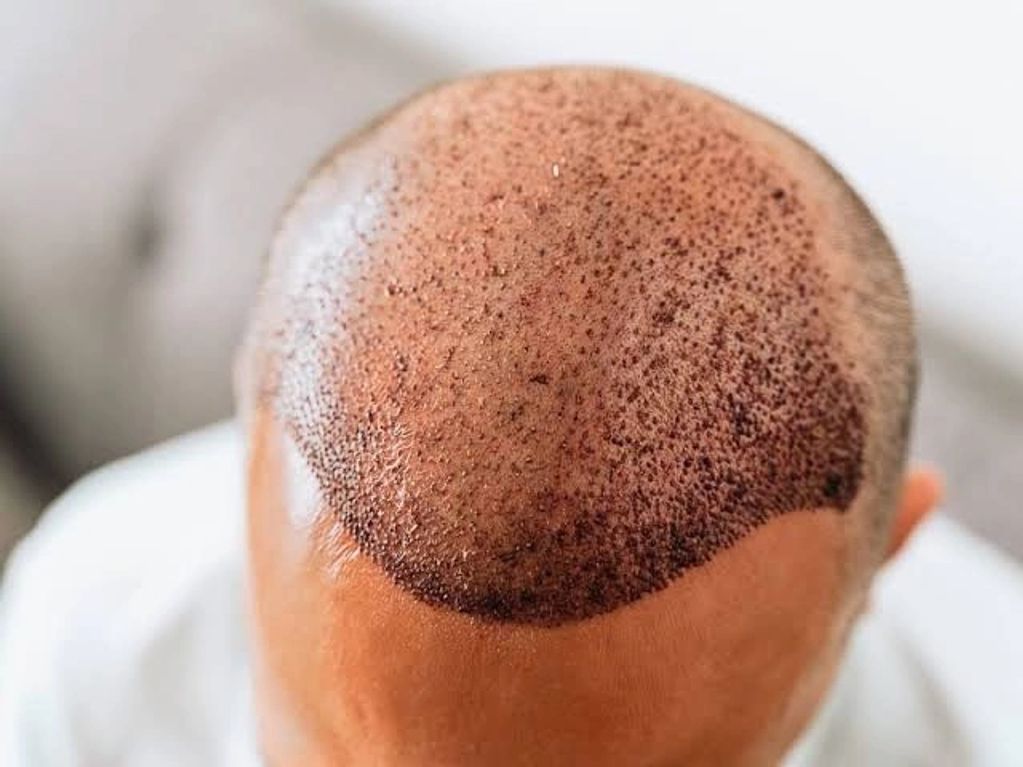 HAIR TRANSPLANT