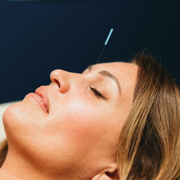 Woman receiving acupuncture treatment with a needle in her forehead.