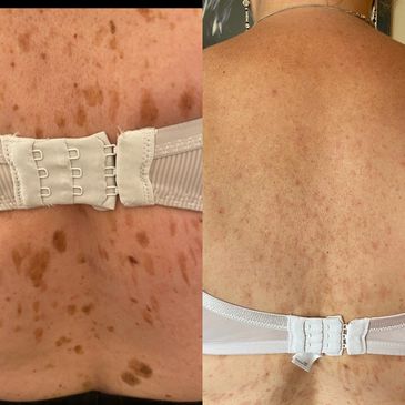 Darker patches
Freckles
Age Spots  
Sun spots
Some brown birthmarks
Marks left from scars
Moles
